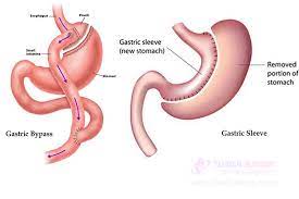 Ramirez, experienced bariatric surgeons, explain the difference between the two have you considered a gastric sleeve instead? Gastric Sleeve Surgery Vs Gastric Bypass Surgery Which One Is Better