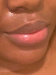 There was a dermatologist quoted on this board that said: Your Skincare Fav On Twitter The Purging On My Forehead And Cheeks Nose From Differin Is Minimal This Time Around But As I Said Purging Doesn T Only Happen In Areas That You