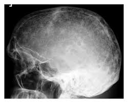 Assigning a stage and a risk category. Multiple Myeloma A Review Of Imaging Features And Radiological Techniques
