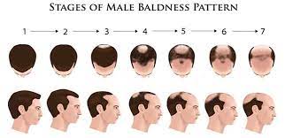 Beard growth is fueled by male hormones, lower levels may cause beard loss. Male Pattern Baldness And Causes Solution Hair Sure