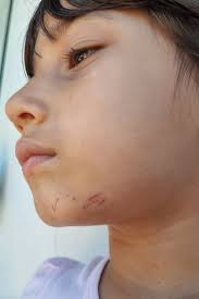 Dermatite atópica: mãe conta desafios de filha com a doença crônica