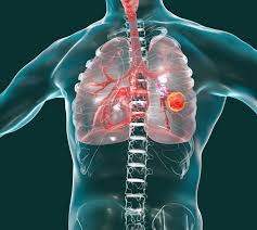 Image result for Lung Cancer