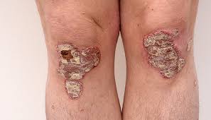 Reflux är återflödet av syra från magsäcken till matstrupen, som kan bli inflammerad och smärtsam. Psoriasis Ar Mer An Bara Hudsjukdom Janusinfo Se