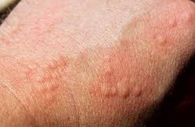 Differenza tra allergia e intolleranza alimentare. Orticaria Cause Sintomi Rimedi Naturali E Come Riconoscerla Foto Greenme