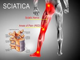 Quickly tighten the buttocks, strengthen muscles allow the following 2 exercises. Sciatica Back In Action