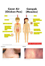 Parut chicken pox atau jerawat dan jeragat dapat dihilangkan. Klinik Avicenna Jangan Keliru Antara Campak Measles Facebook