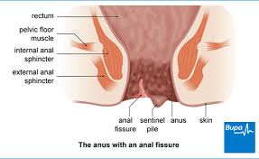 Anal Fissure Health Information Bupa Uk