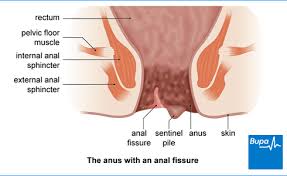 anal fissure health information bupa uk