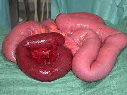 Notfall Ileus Klinik Via Medici