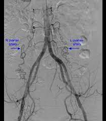 Ovarian Artery Radiology Reference Article Radiopaedia Org