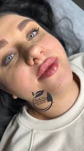 فیلر لب تکنیک M 💉👄 #فیلر #فیلرلب_روسی #بوتاکس_صورت #مادلینگ_صورت #لب