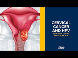 Image result for human papillomavirus symptoms