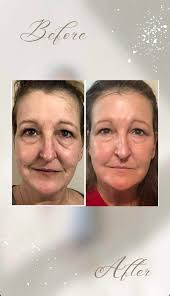 New facial bar for oily skin