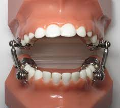 Appliances You May Receive Throughout Your Treatment Dr Carrie Webb Orthodontist