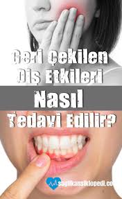 Geri Cekilen Dis Etleri Nasil Tedavi Edilir Disetleri Dogaltedaviler Disetisorunlari Disetihastaliklari Saglikansiklopedi Natural Health Health