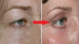 Yumurta Aki Ile Goz Kapagi Dusuklugu Tedavisi Dogalmaskeler Guzell Aki Almaskeler Dogalmaskeler Dusuklugu Goz Guzel Kapuzen Augen Augen Behandlung
