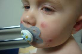 Generally speaking, spots are four to 10 millimeters in diameter—like a pinpoint—and cluster in a concentrated area. Derm Dx A 10 Month Old Boy With Purpuric Plaques Clinical Advisor