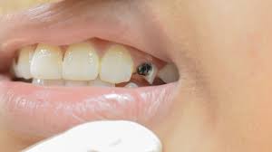 Mengetahui Jenis Karies Gigi Untuk Langkah Penanganan Berkeluarga