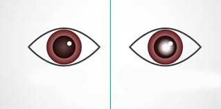 الجلوكوما الغلوكوما المياه الزرقاء الزرق الماء الاسود في العين Glaucoma طبيب دوت كوم