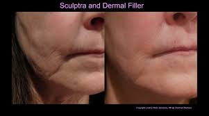 Usually fillers and injectables are enough to treat mild jowls (more information on procedure, cost and effects of fillers in my article here). Do You Want To Breakup With Your Jowls Charmed Medispa