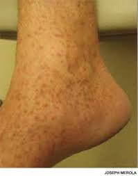Image result for brown patches on the feet