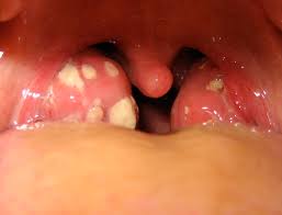 Hpv can infect the mouth and throat and cause cancers of the oropharynx (back of the throat, including the base of the tongue and tonsils). Tonsillitis Quinsy Abscess Antibiotics Teachmesurgery