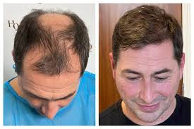 FUE Hair Transplant Cost UK [2024]