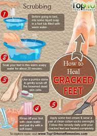 How To Heal Cracked Feet Top 10 Home Remedies