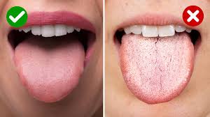 Image result for cancer of tongue