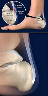 Haglund syndrome, haglund^s deformity, achilles tendon tenopathy, conservative treatment and surgical correction. Resection Of Haglunds Deformity Central Coast Orthopedic Medical Group