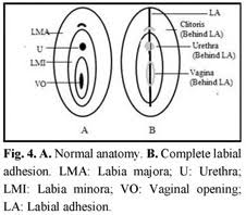 Image result for Labial Fusion