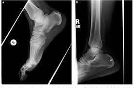 Surgical Management Of Insertional Calcific Achilles Tendinosis With A Central Tendon Splitting Approach Semantic Scholar