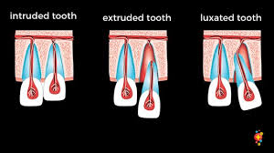 Image result for Tooth Avulsion