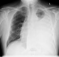 Real answers for those with mesothelioma. Pleural Mesothelioma Radiology Case Radiopaedia Org