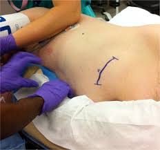 Image result for Intrathecal Pump