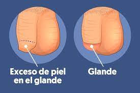 Fimosis En Ninos Tipos Sintomas Y Tratamiento Tips De Madre