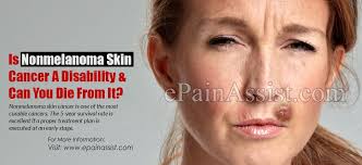 The most important warning sign of melanoma is a new spot on the skin or a spot that is changing in size another important sign is a spot that looks different from all of the other spots on your skin (known as the ugly duckling sign). Is Nonmelanoma Skin Cancer A Disability Can You Die From It