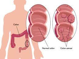 It affects the intestines and other lymphatic tissues (commonly the abdominal organs). Colon Cancer Information Overview My Colon Cancer Coach