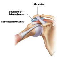 Bigliani, l.u., morrison, d.s., april, e.w. Schulterspezialist Berlin Impingementsyndrom