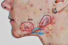 赫铂国际皮肤管理小知识 腮边痘 些那 事 腮边 主痘 要是长 肝期 胆 超负荷 巴淋 毒排不畅引起 要主 在耳 际 子脖 脸和 交界处产生 复反 发爆在 同一位置 重 会严 形成 节结 建议 1 早睡 少熬 夜 watercolor tattoo watercolor tattoos