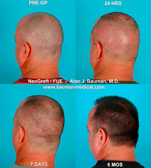 Behnam, has performed over 2,500 procedures without any incident at his clinic serving la. Best Neograft Fue Treatment In Florida Bauman Medical