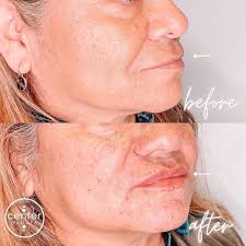 𝓟𝓻𝓸𝓯𝓲𝓵𝓮 𝓔𝓷𝓱𝓪𝓷𝓬𝓮𝓶𝓮𝓷𝓽 ✨ a little bit of filler can go a  long way- this patient was experiencing volume loss in her cheeks & needed  just a little refreshing! Subtle enhancements make the