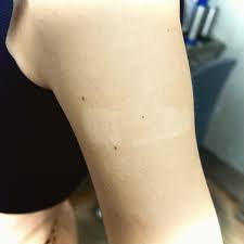 Image result for Postinflammatory Hypopigmentation