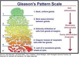 If breast cancer is diagnosed at an early enough stage, it's treatable. Gleason Score Prostate Conditions