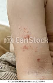 Det finns ingen botande behandling mot tbe och ca 1/3 av vuxna som insjuknat får bestående men. Arm Herpes Barn Herpes Orsakat Blasor Hand Zoster Arm Child Canstock