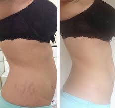 Bio Oil Before And After Burn Scars Pin On Before And After Frank
