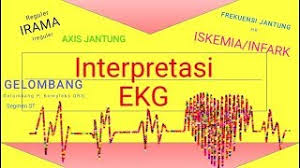  kertas ekg merupakan kertas grafik dengan jarak 1 mm (disebut 3. Interpretasi Ekg Dengan 5 Langkah Part 1 Youtube