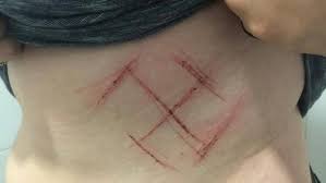 A suástica é a cruz em movimento; Laudo De Jovem Marcada Com Suastica Sugere Consentimento Ou Automutilacao Badalo