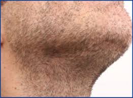 However, beard hair loss may result from psychological factors, such as mental stress, possibly extending to physical stress, asthma and allergies. Harvesting Beard Hair For Scalp Transplantation Hair Transplant Forum International