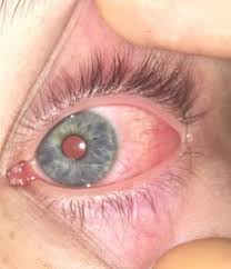 Auge Juckt Ist Rot Tut Weh Und Angeschwollen Bindehautentzundung Schwellung Rote Augen